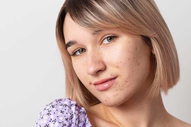 Грибок на лице: симптомы и способы лечения